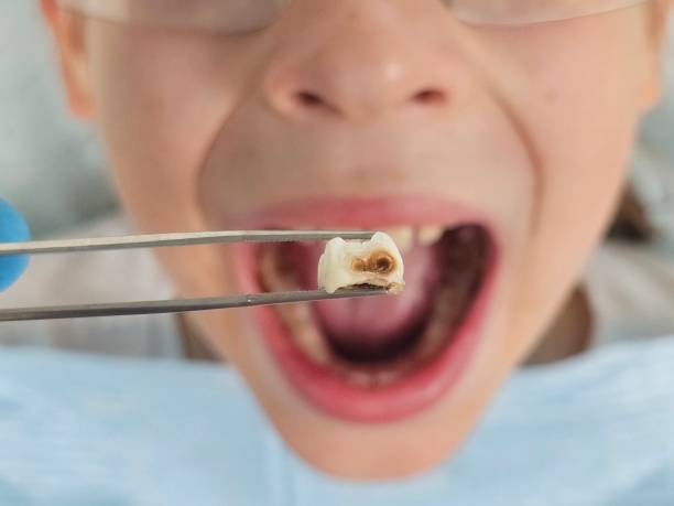 Best Emergency Root Canal Treatment in Shelbyvle, IL